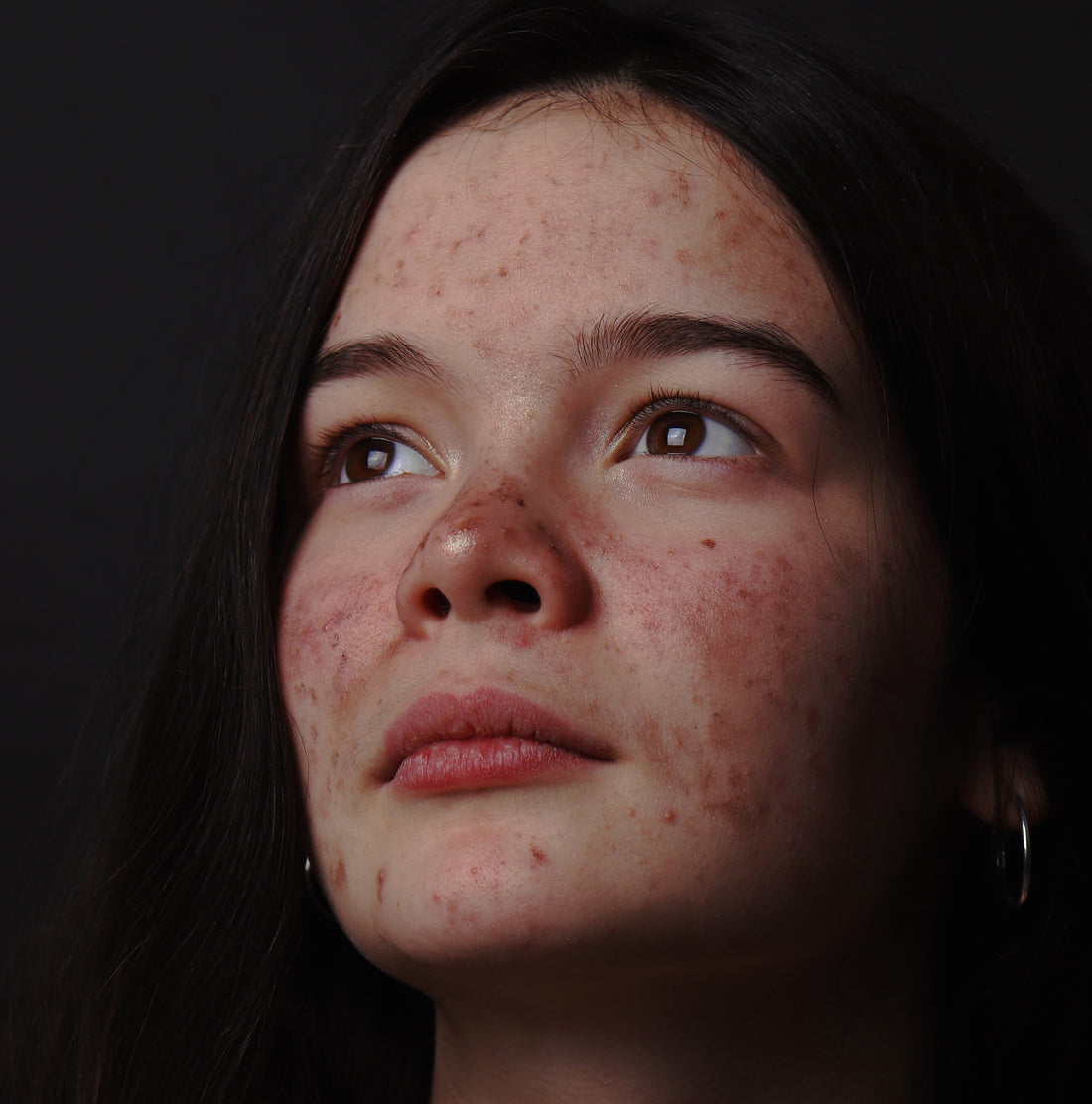Why Everything You Think You Know About Hormonal Acne is Wrong