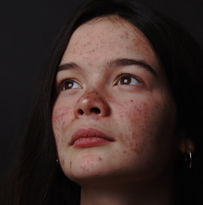 Why Everything You Think You Know About Hormonal Acne is Wrong